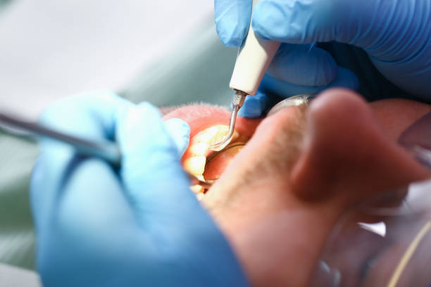 Best Emergency Tooth Extraction in Cedar Falls, IA